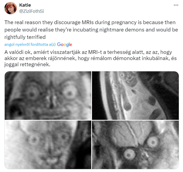 magzat mri